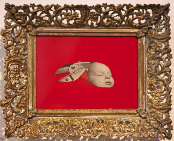 Circumcision or Vasectomy